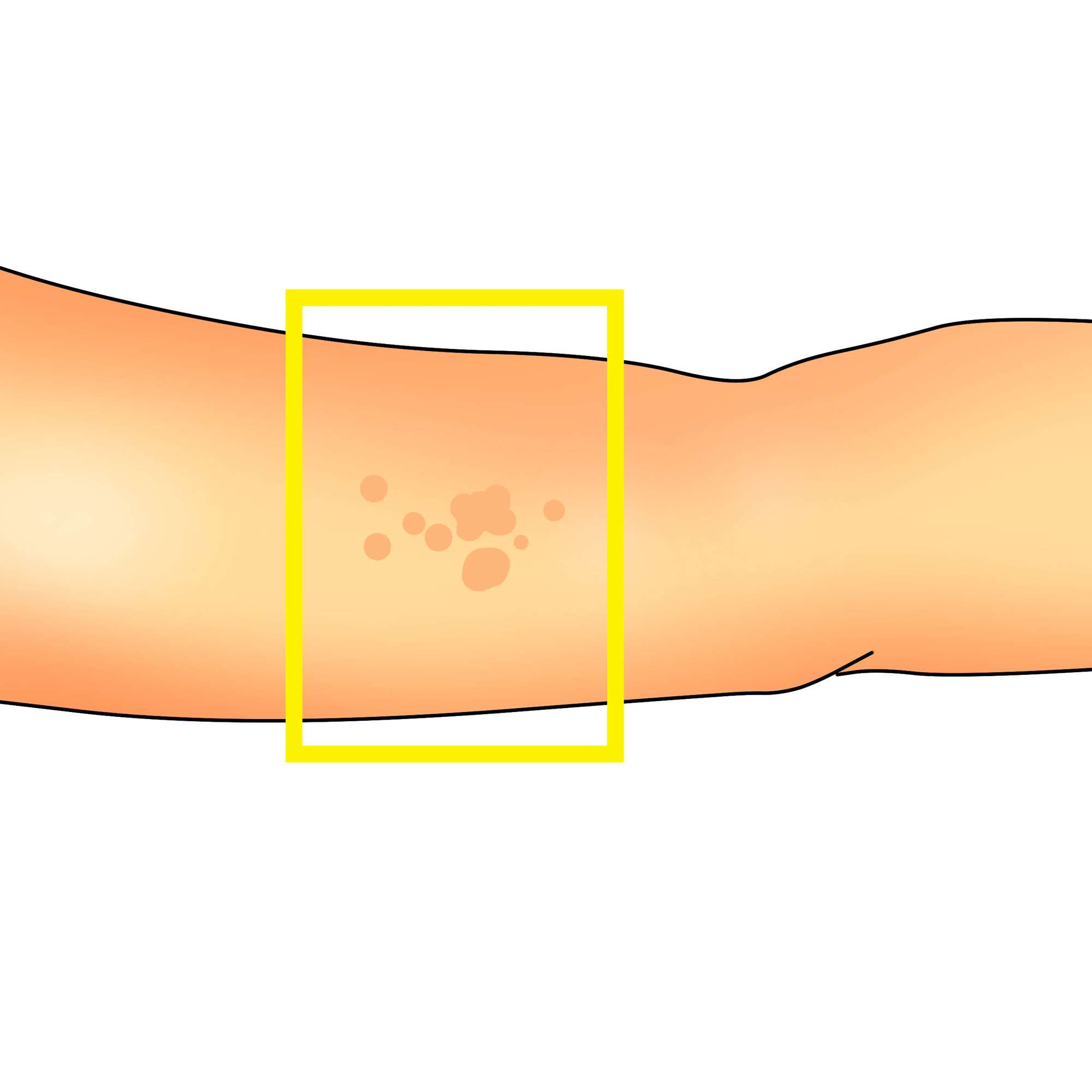 Common wart on the arm