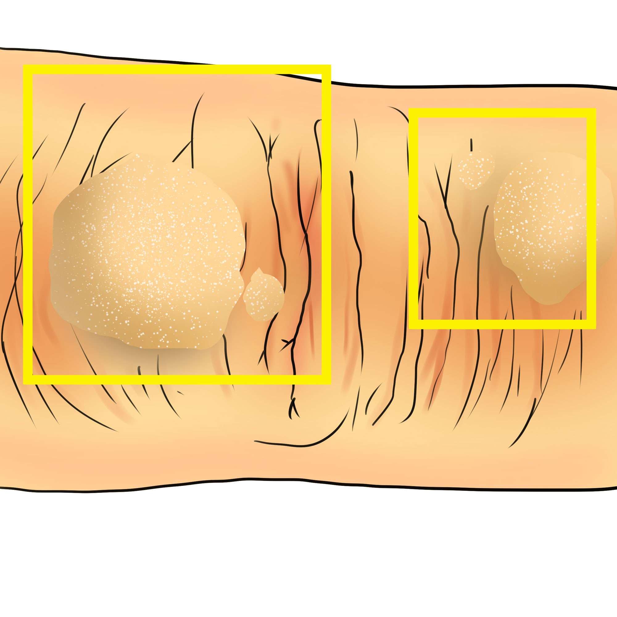 Common wart on a single finger