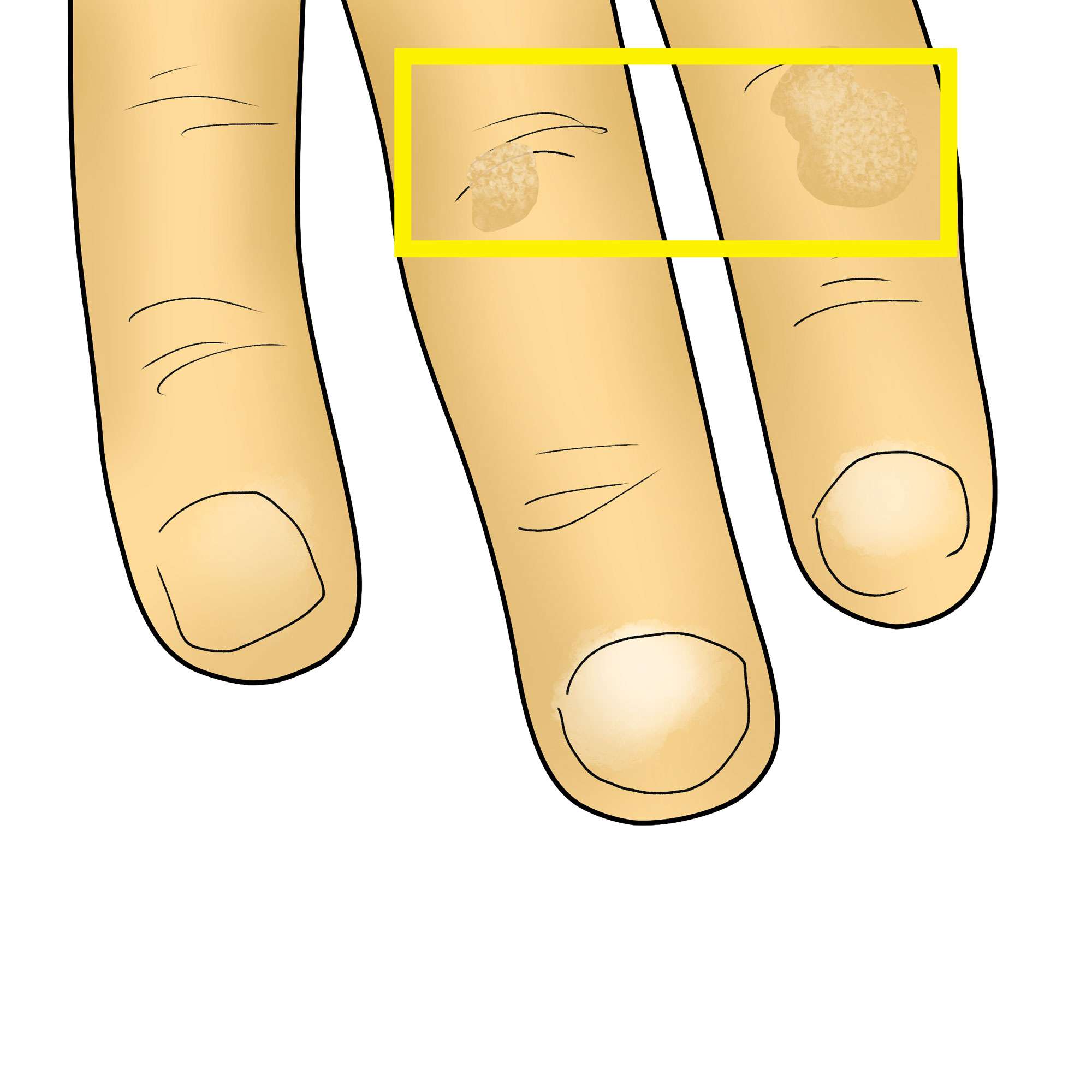 Common warts on the fingers