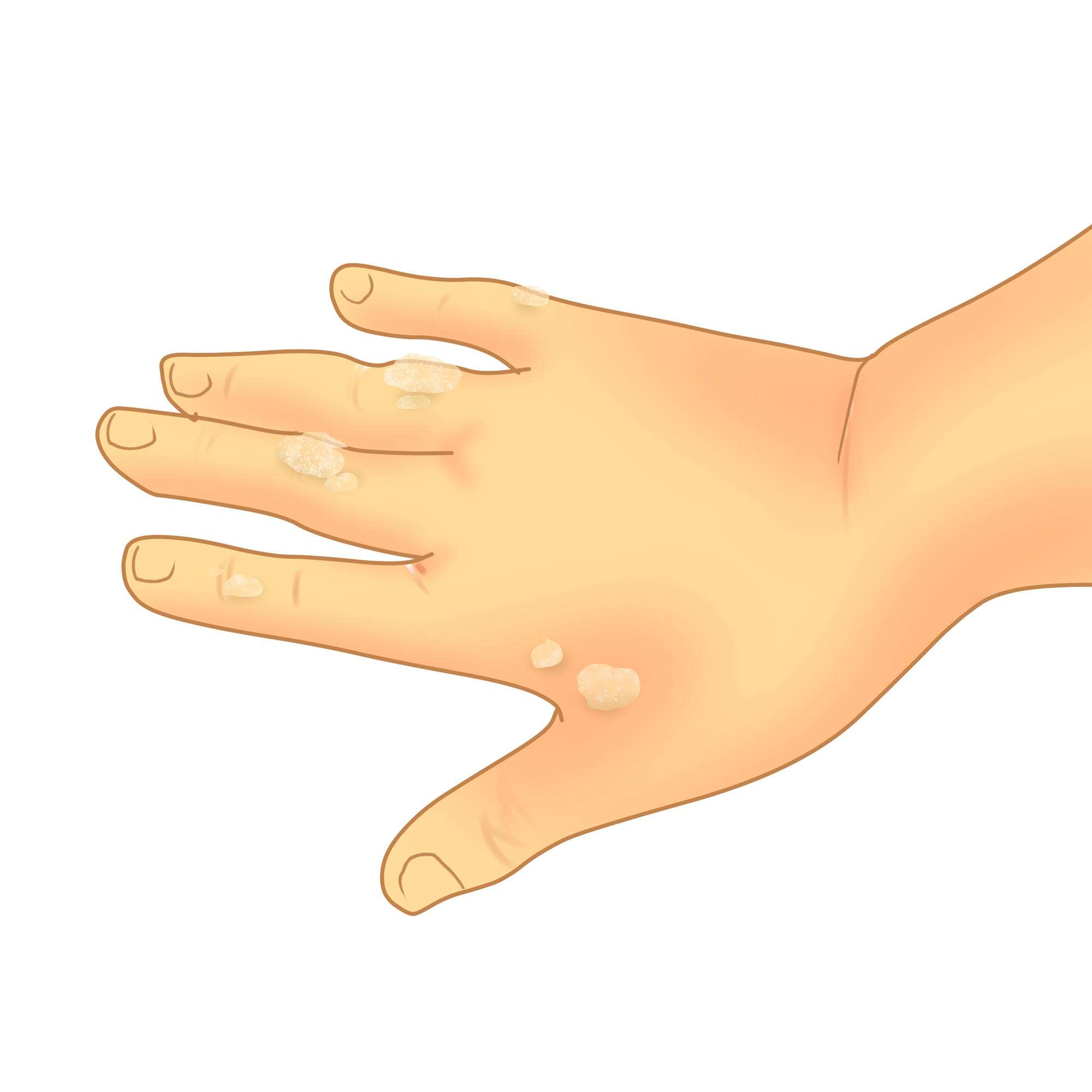 Common wart on the hand