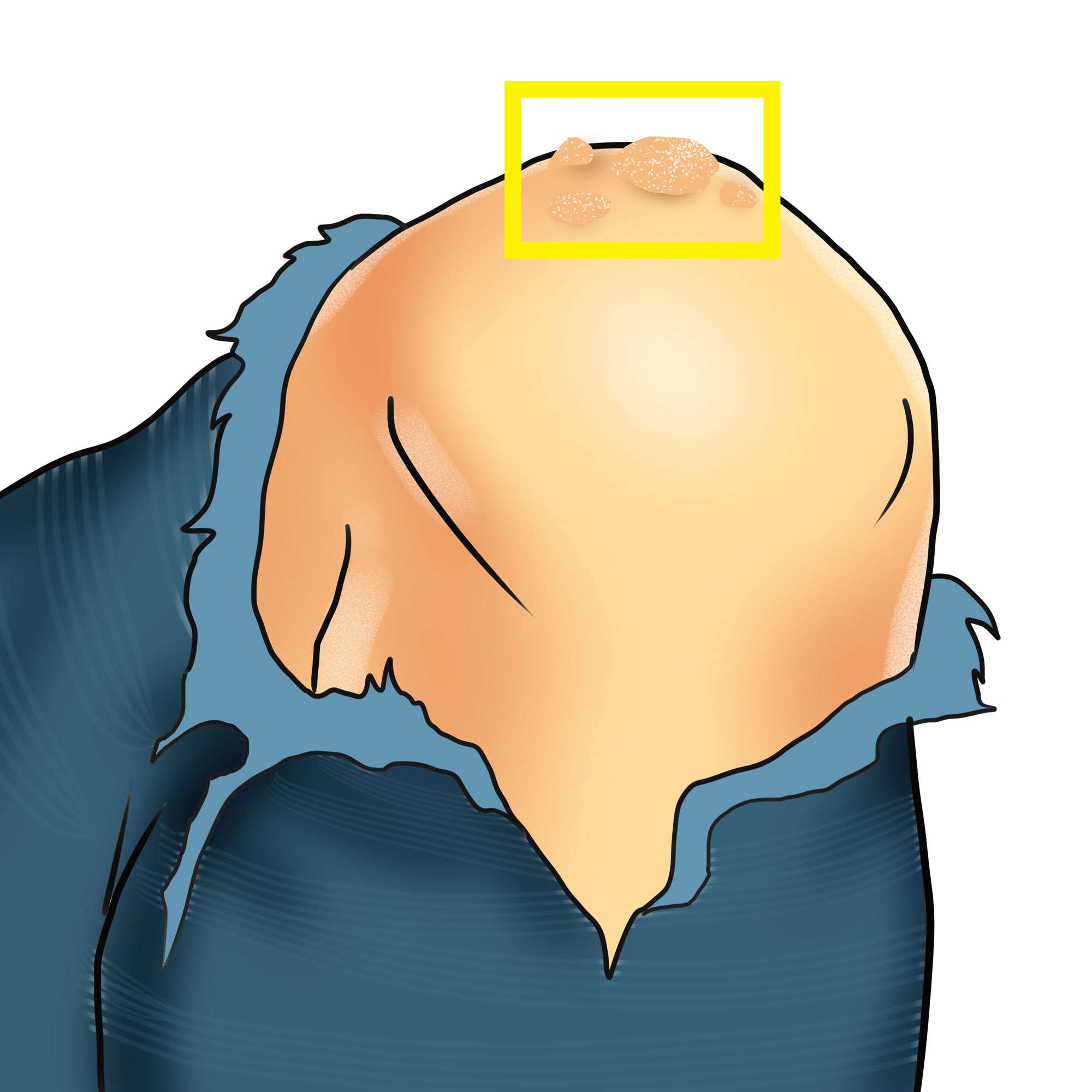 Common wart on the knee
