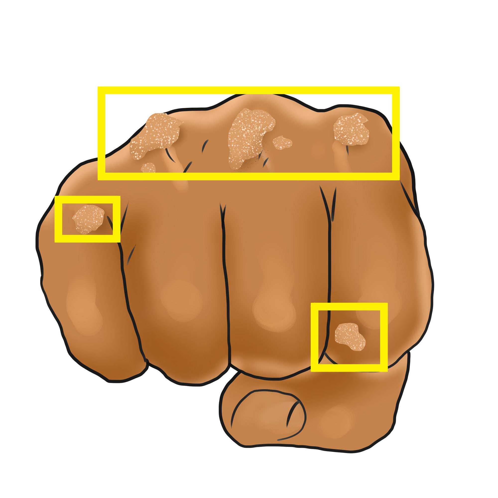 Common wart on the knuckles