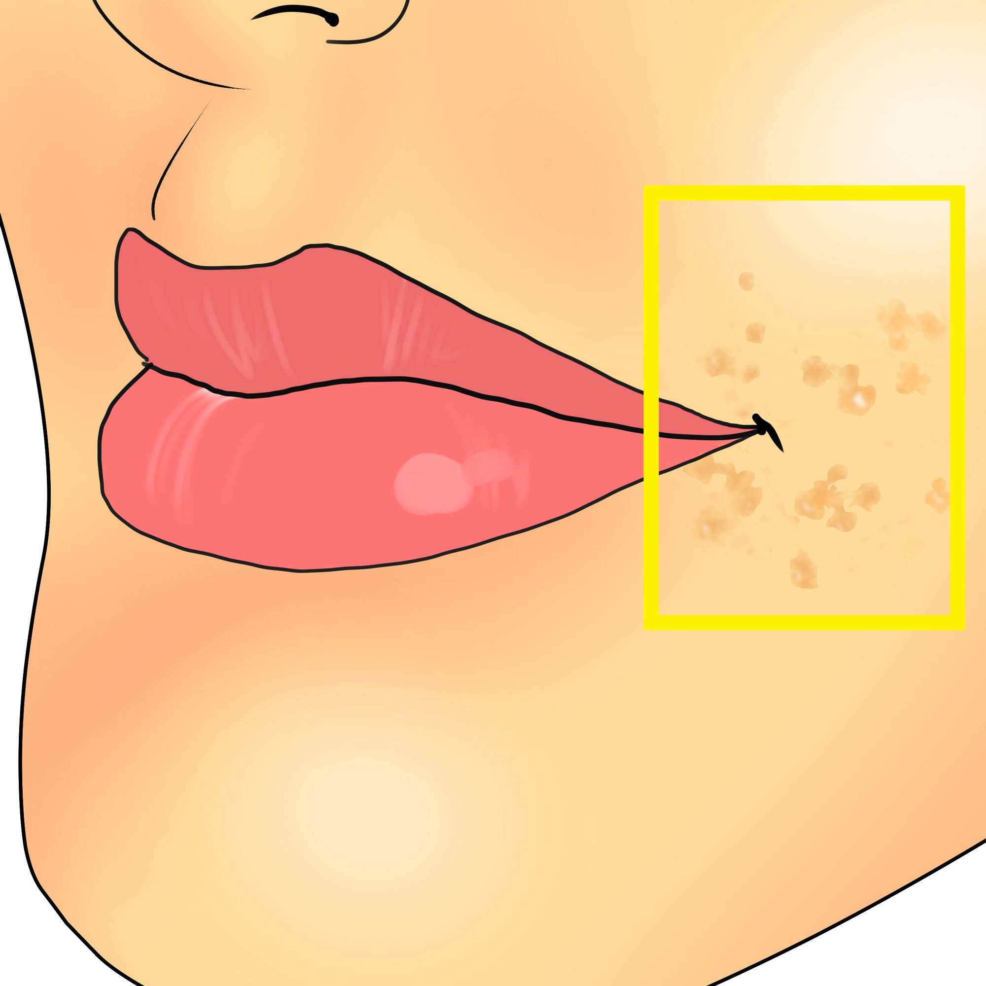 Flat warts near the lips