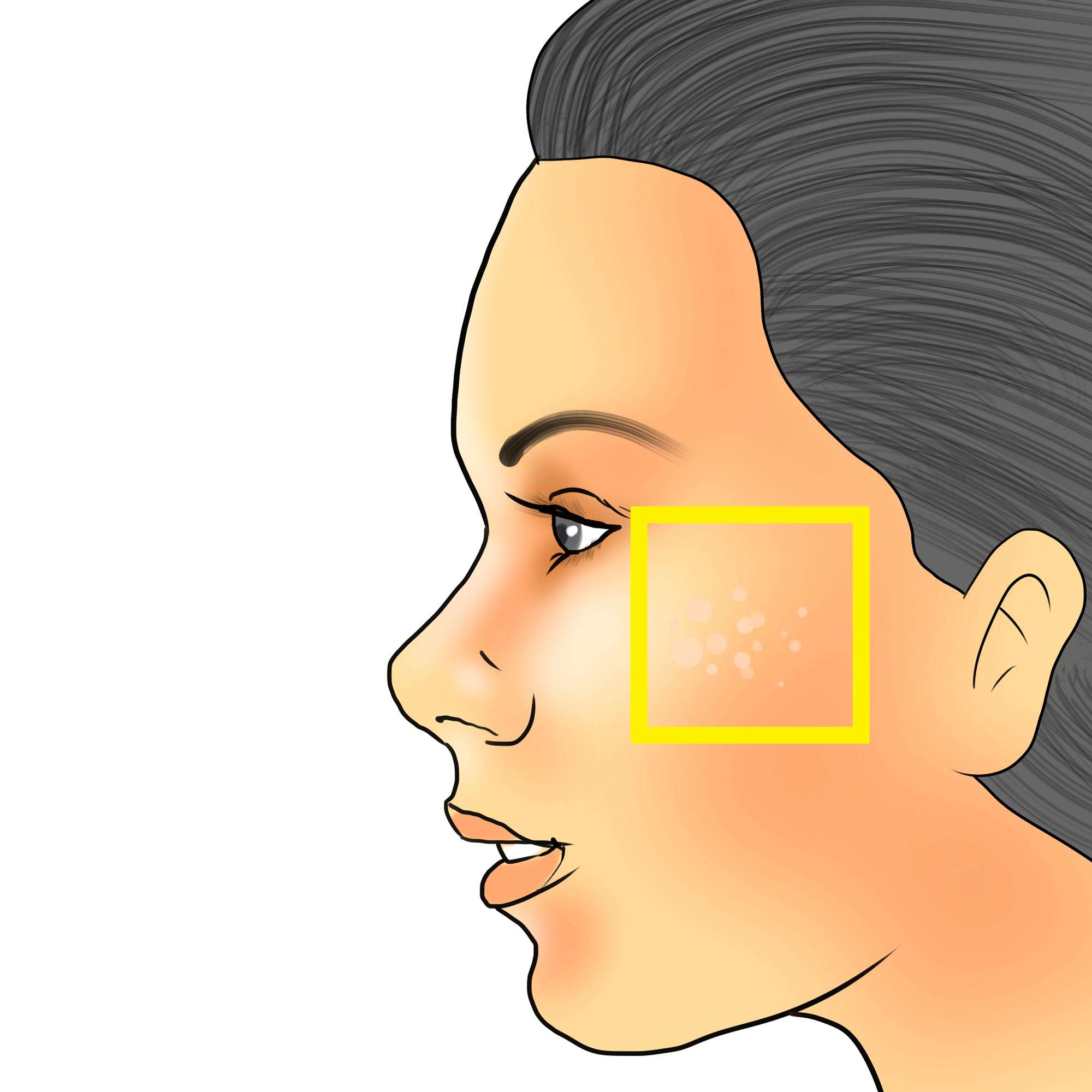Flat warts on the cheek