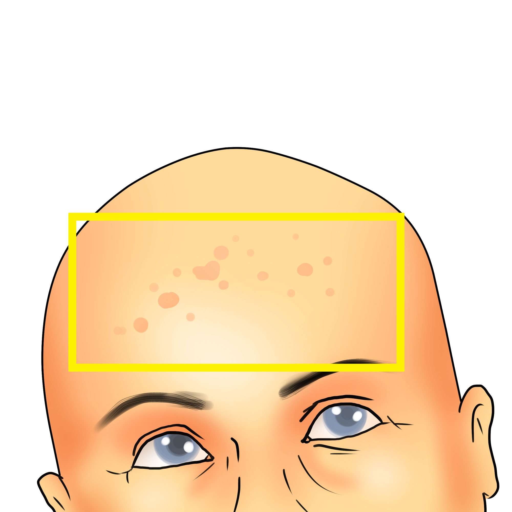 Flat warts on the forehead
