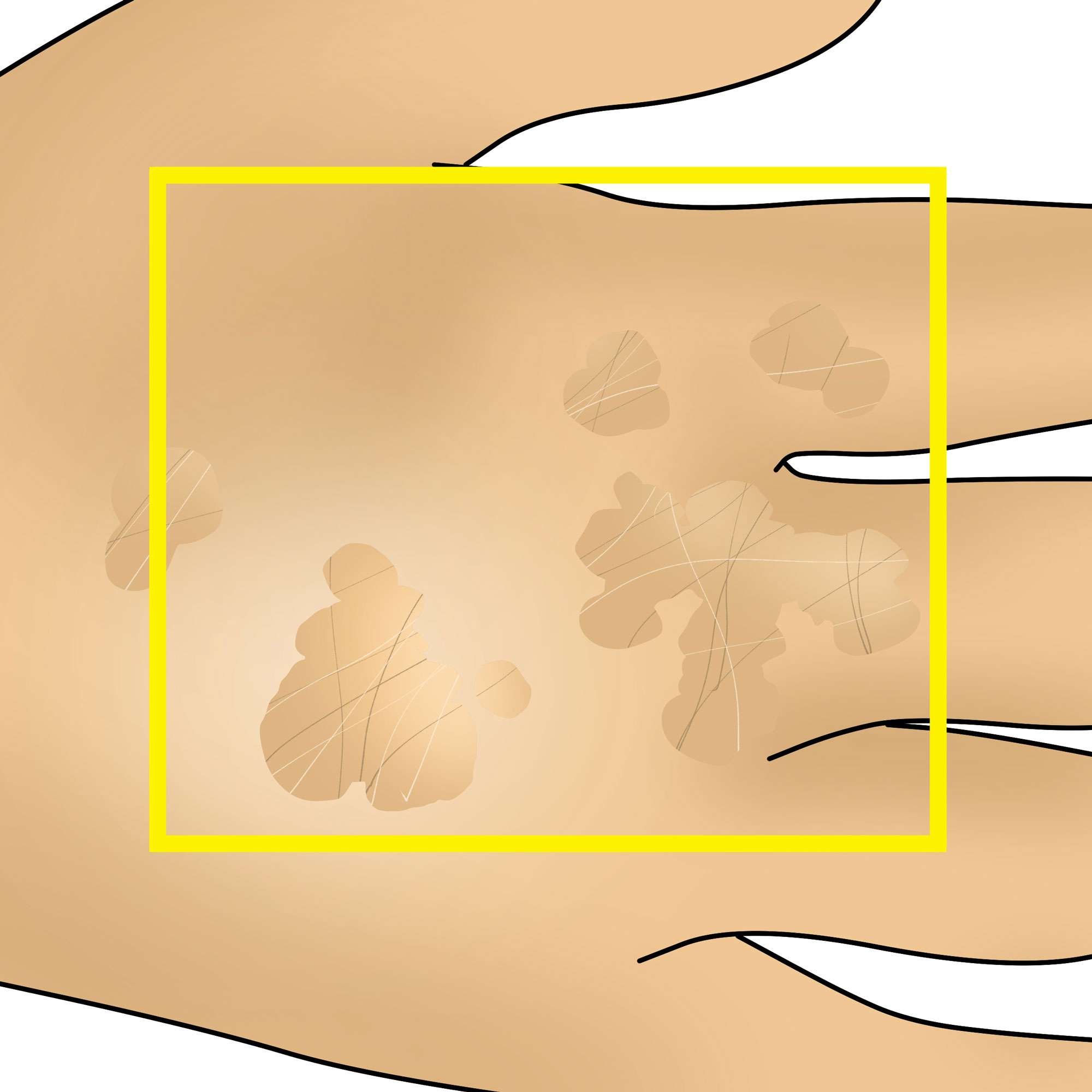 Flat wart on the hand