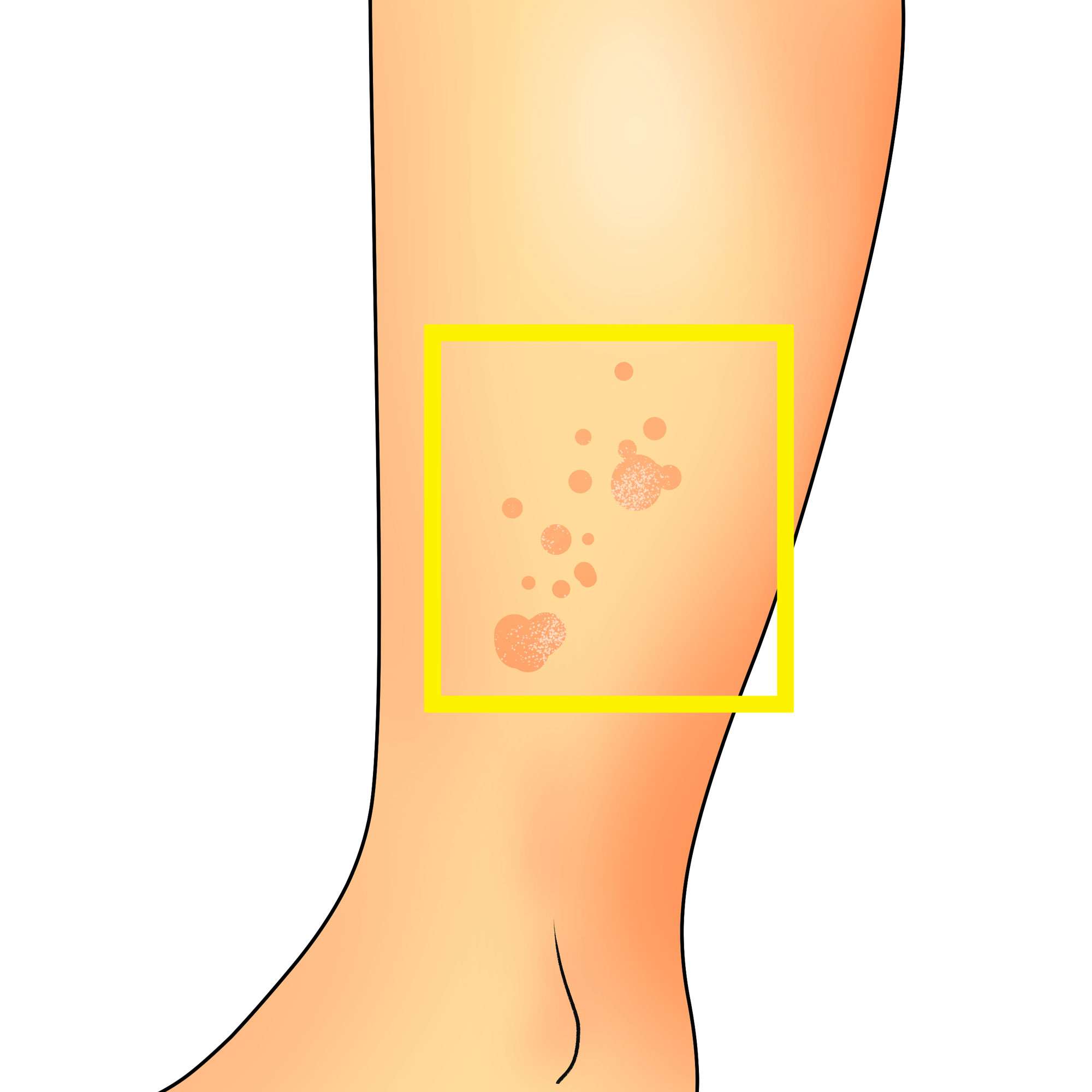 Flat warts on the leg
