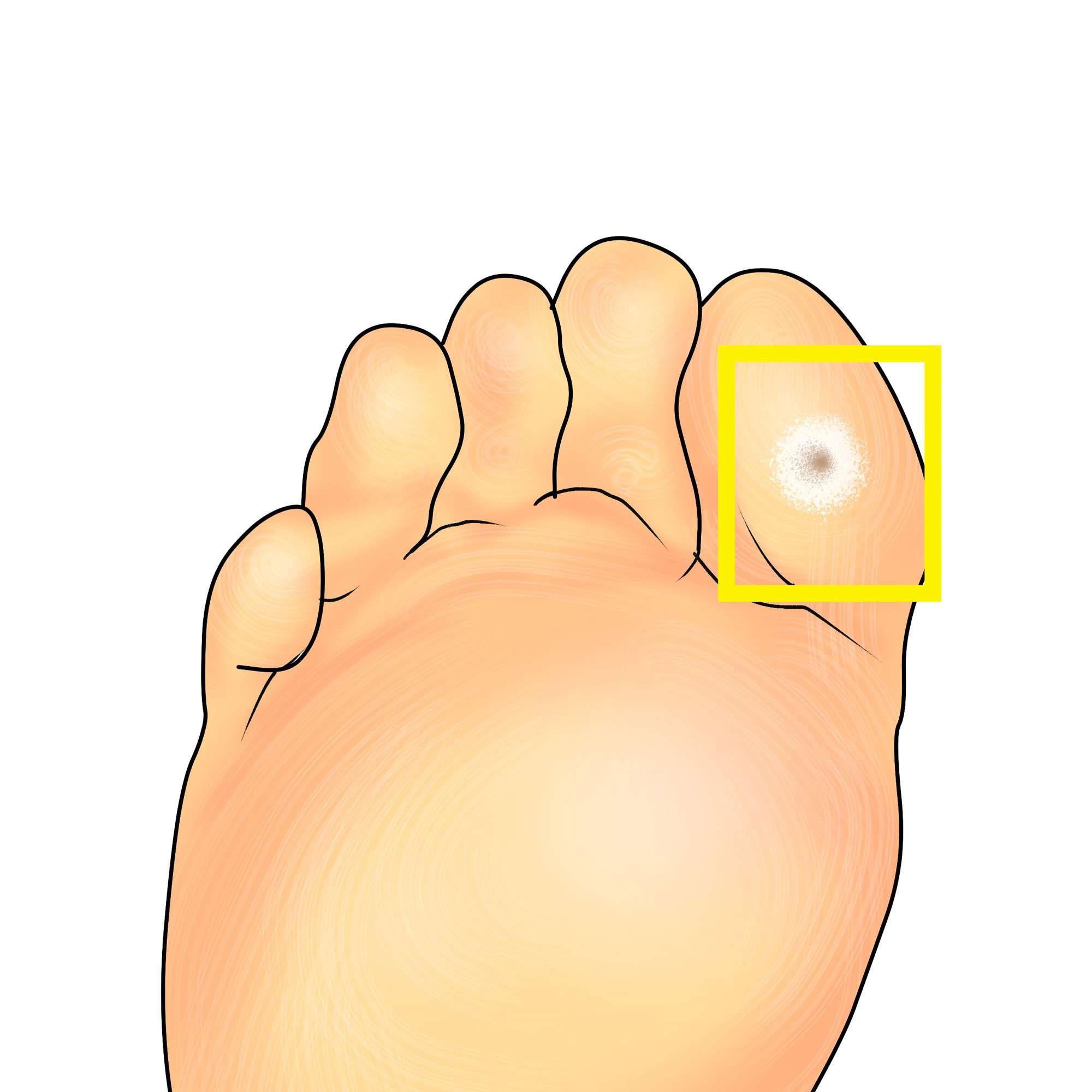 Plantar wart on the big toe