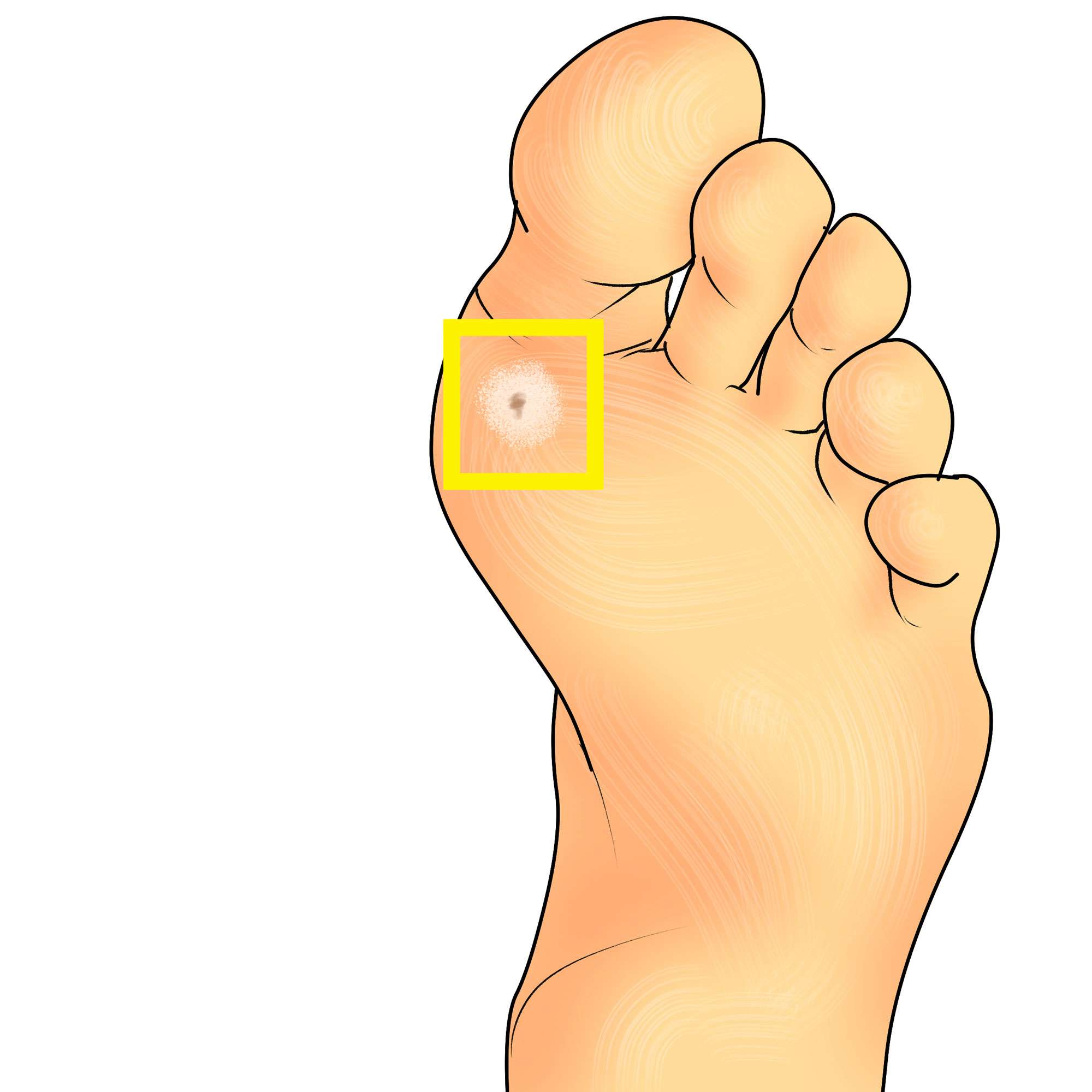 Plantar wart on the sole of the foot