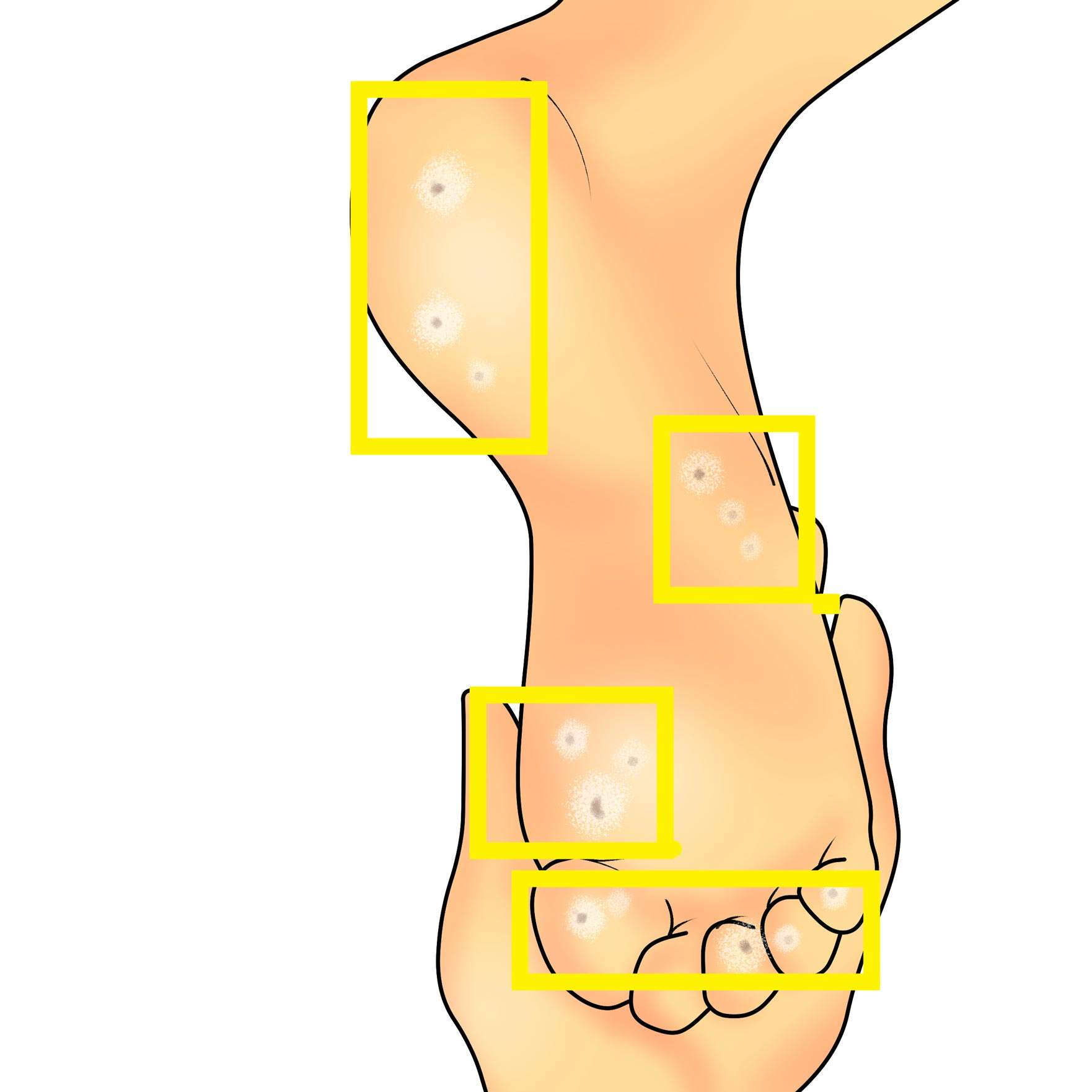 Plantar wart on the foot