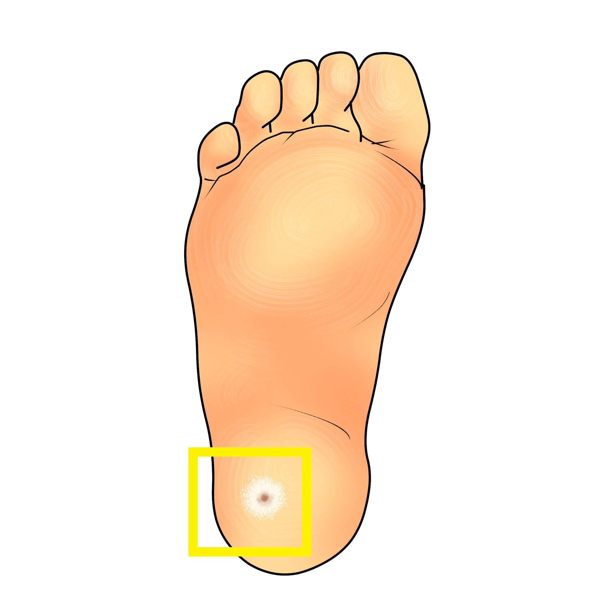 Plantar wart on the heel
