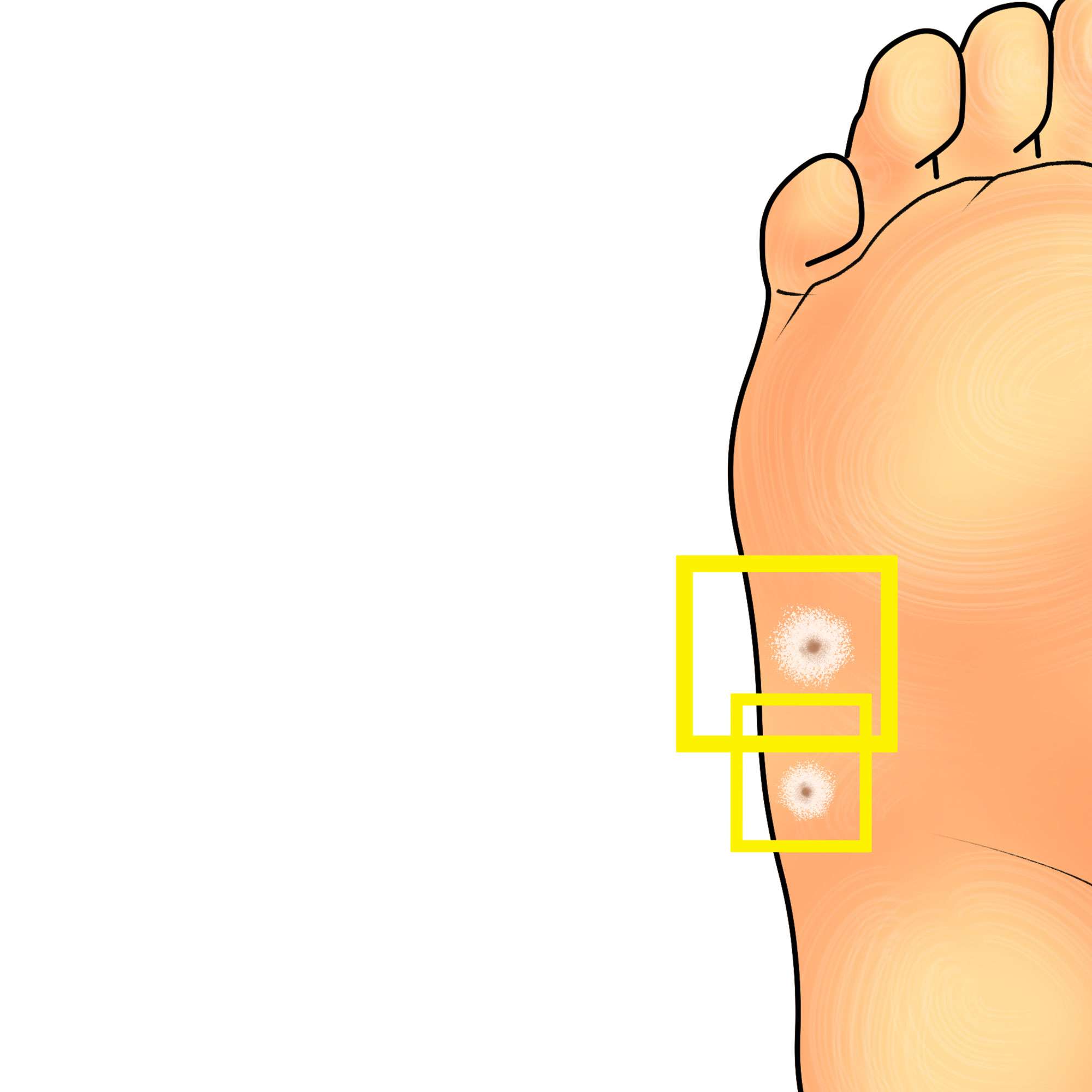 Plantar wart on the side of the foot