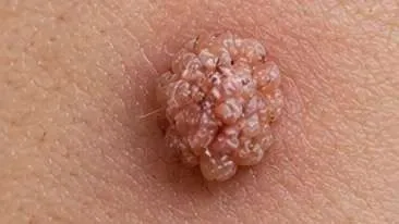 Before using Wartovir