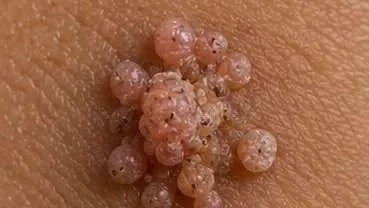 Before using Wartovir