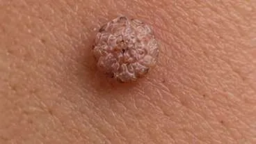 Before using Wartovir